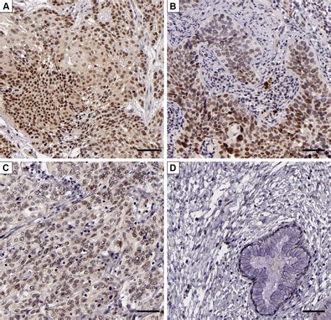 Representative Immunostaining Of Bcl3 In Cc And Adjacent Cervical