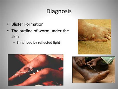 PPT - Dracunculus medinensis PowerPoint Presentation - ID:630005