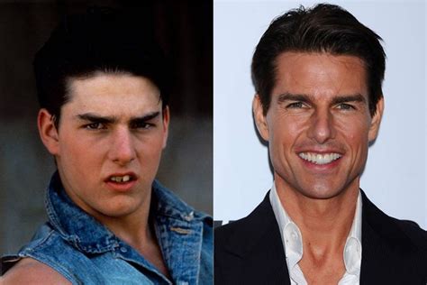 Tom Cruise Teeth Alignment : What S Happened To Tom Cruise S Teeth ...