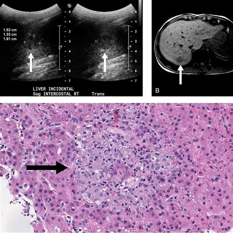 Ultrasound demonstrating (A) 1 of 2 identified nonspecific hypoechoic ...