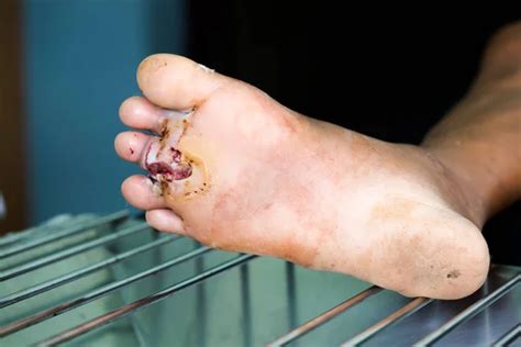 Infected Wound Of Diabetic Foot — Stock Photo © Itpnpc