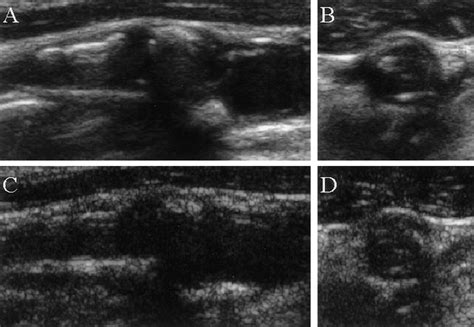 Characterization Of Carotid Artery Plaques Using Real Time Compound B