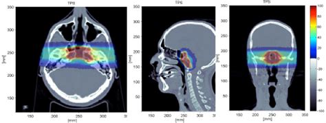 Simulated treatment plan of a chordoma as displayed by the Treatment... | Download Scientific ...