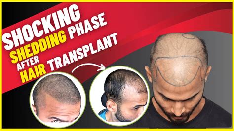 Science Behind Shedding Phase After Hair Transplant My Honest