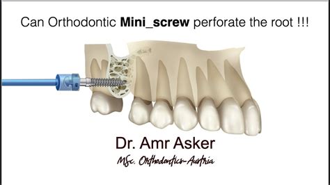 Mini Screw In Orthodontics What Will Happen If You Touch The Root By