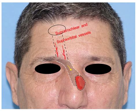The Frontal Hairline Island Flap With Evidence Of The Vascular