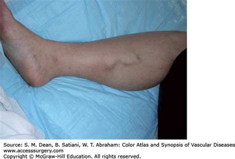 Acute Superficial Venous Thrombosis Evaluation And Treatment