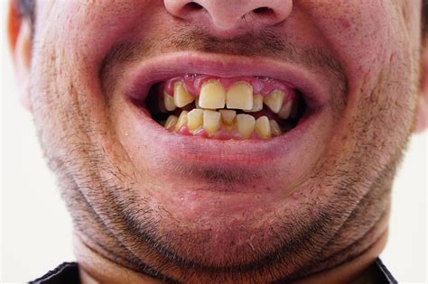 Ugly Teeth Smile