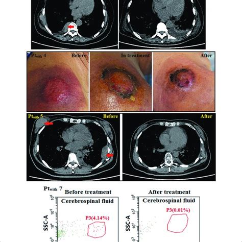 | The efficacy to the extramedullary disease. The skin lesion far from