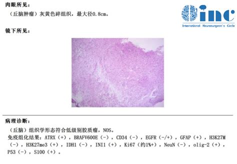 开颅术后“零并发症”，inc巴教授丘脑胶质瘤安全手术纪实 Medscicn