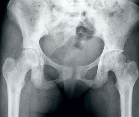 Collection Images What Does An X Ray Of The Hip Show Superb