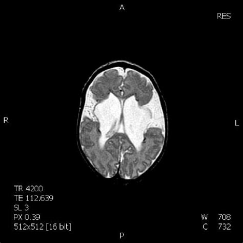 Open Lip Schizencephaly SE T 2 Weighted Image Showing Localized