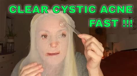 Clear Cystic And Hormonal Acne Fast High Frequency Benefits Part 1