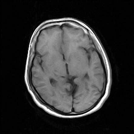 Septo Optic Dysplasia With Schizencephaly Image Radiopaedia Org