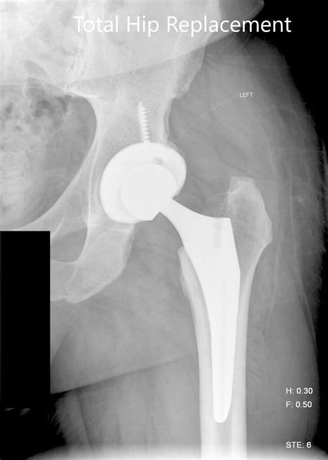 Case Study: Left Hip Total Replacement in 54 Year Old Female