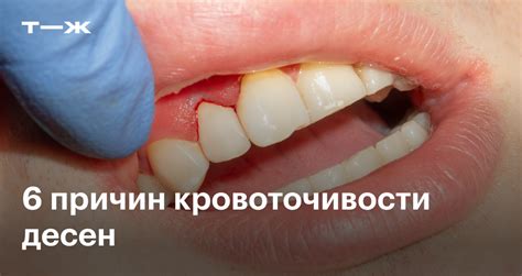 Почему кровоточат десны при чистке зубов: список причин