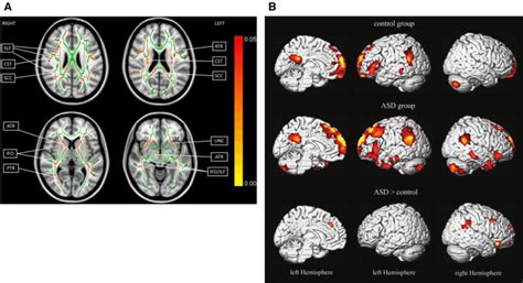 abnormal brain structure  function   mechanism  empathic