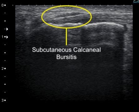 Subcutaneous Calcaneal Bursitis - Ankle, Foot and Orthotic Centre