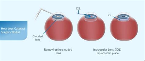 Breast Cancer Radiation And Cataracts Eye Surgery Guide