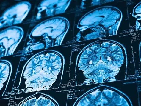 What Is the Difference Between a Traumatic Brain Injury vs. Concussion ...