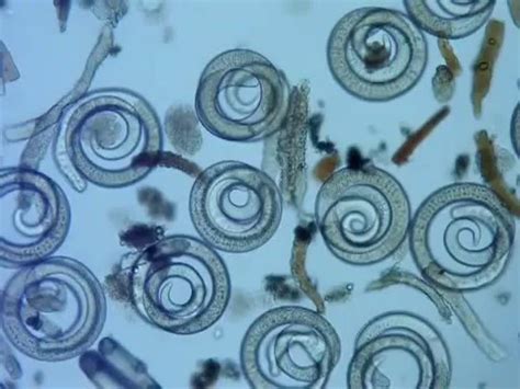 Трихинеллез (трихинелла). Трихинеллез у человека - YouTube