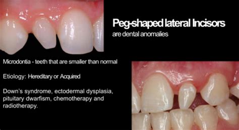 Cd5 Peg Lateral Incisors Restoration Quiz 1 Flashcards Quizlet