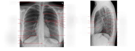 Diagram Radiologie Anatomie X Thorax Quizlet