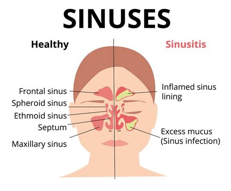 Sinusitis Treatment Nyc By Marc Bystock L Ac