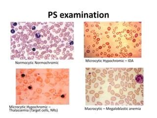 Hypochromic Anemia Ppt