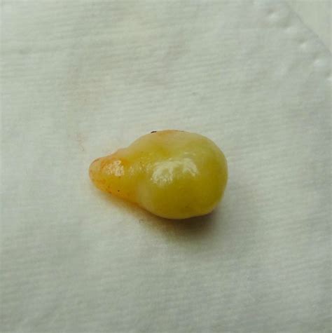 Удаление атеромы в Москве | Лечение атеромы