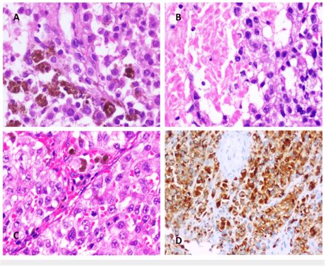 A Hematoxylin And Eosin H E Stained Sections Show Sheets Of