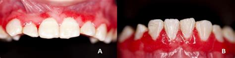 A And B Maxilla And Jaw Respectively Where The Presence Of The Lesions