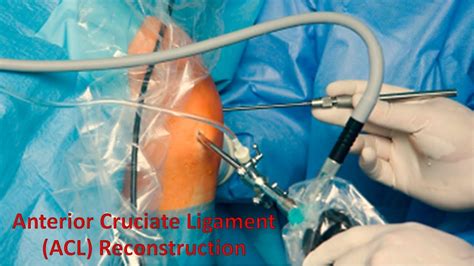 Anterior Cruciate Ligament Acl Reconstruction Knee Surgery By Dr Anil