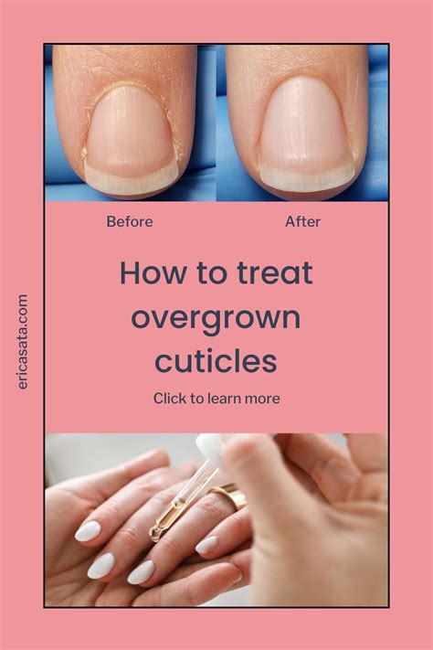 12 Easy Quick Tips To Treat And Prevent Peeling Cuticles Artofit