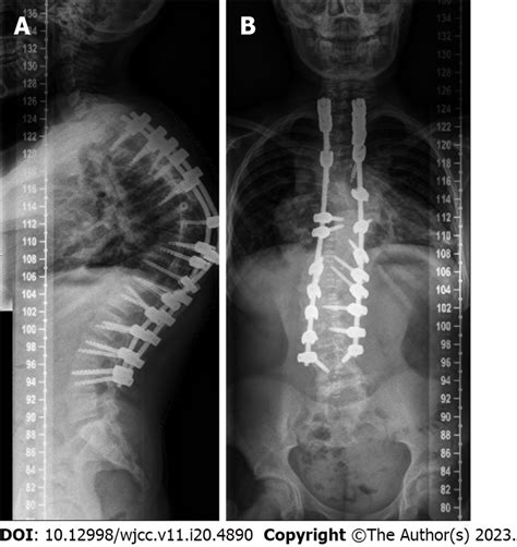 Postoperative X Rays A Lateral View B Posteroanterior View