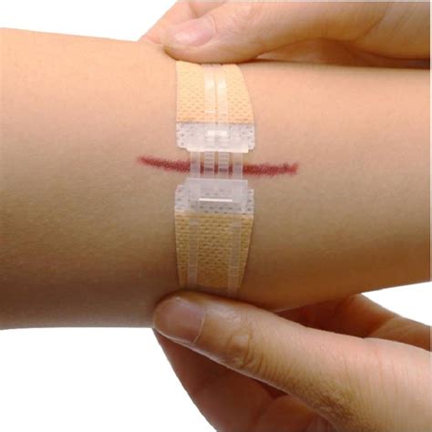 Bluenjoy Medical Wound Closure Device Non Invasive Suture Skin Surface