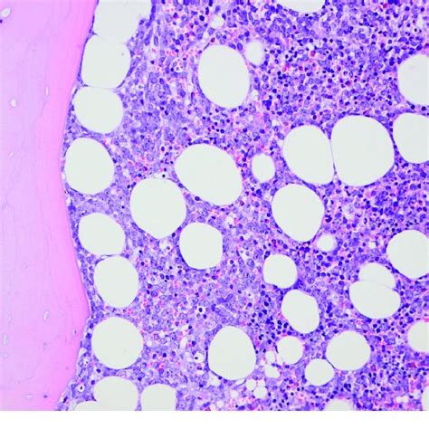 Hematoxylin And Eosin Stained Bone Marrow Biopsy Showing Massive Bone