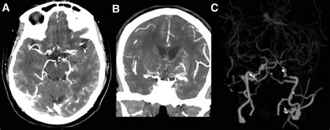 A Axial Cta Image Showing Stenosis Of The Distal Internal Carotid Download Scientific Diagram