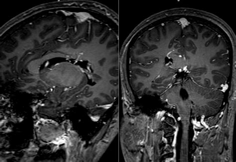 Cerebral Arteriovenous Malformation At Posterior Body Of Corpus