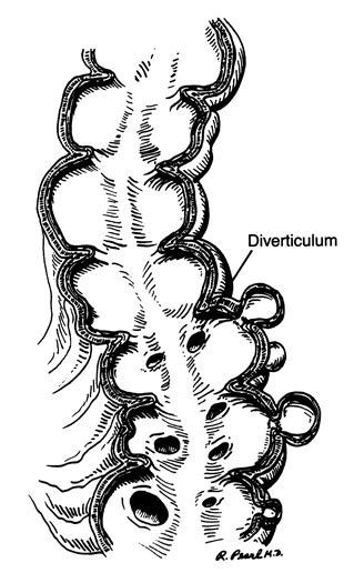 diverticular disease information paul  savoca