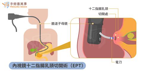 大魚大肉吃出膽結石 手術摘膽囊不復發更防癌