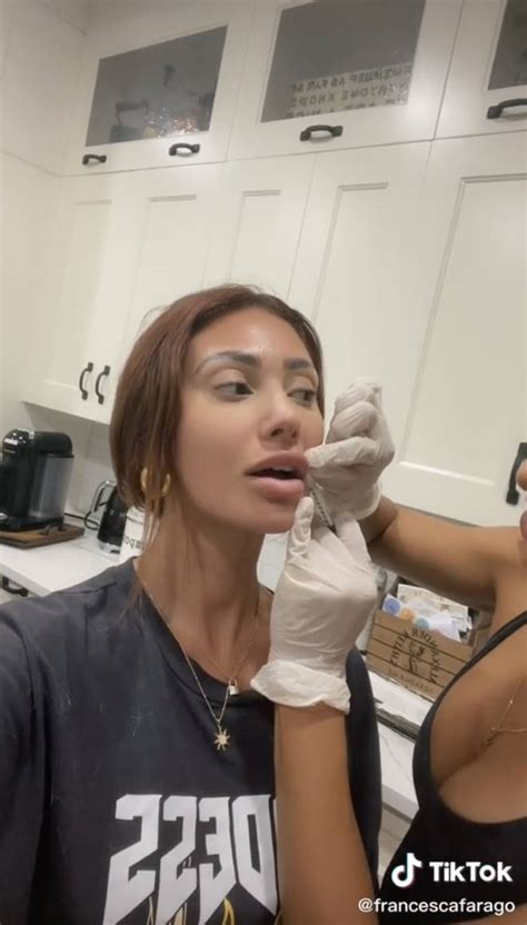 Francesca Farago Reveals Before And After Lip Filler Removal In Photos