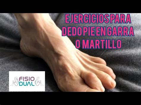 Ejercicios Para Dedos Del Pie En Garra O Martillo Youtube