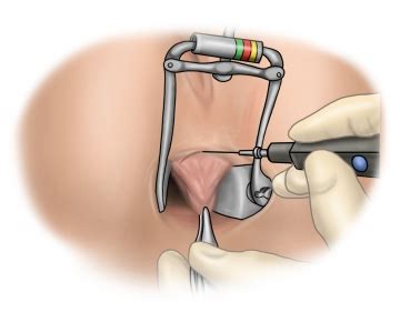 Milligan Morgan Hemorrhoidectomy