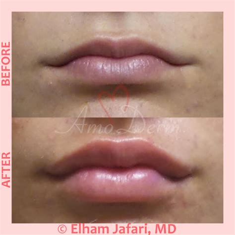 White Spots On Lips After Injections Lipstutorial Org