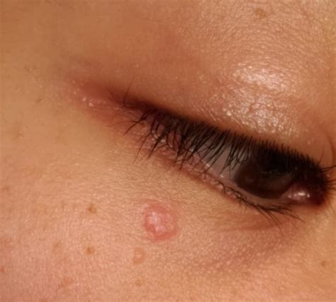 Red Raised Papule Or Skin Lesion Is It Cancerous R