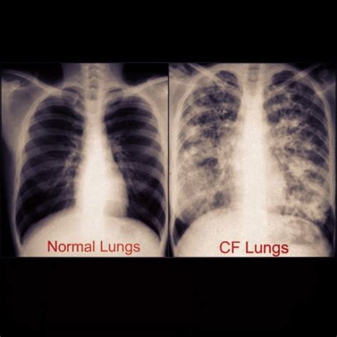 Healthy Lungs And Smokers Lungs X Ray