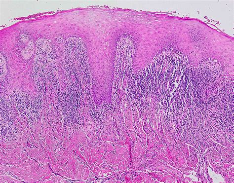 Lichen Planus Histology Sawtooth Sexiz Pix