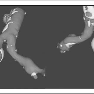 Three-dimensional reconstruction of a computed tomographic scan ...