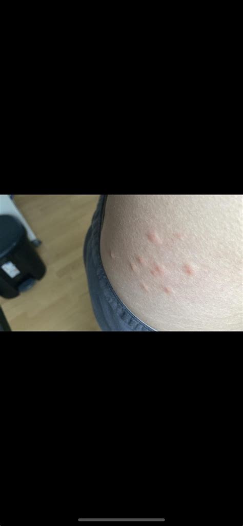 Allergy, mites or bed bug bites? : r/bugbites